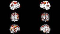 A heat map of areas of decreased brain metabolism during lyme treatment.